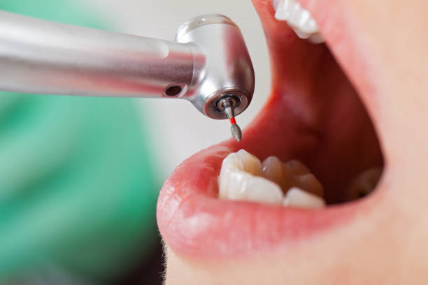 Best Emergency Dentist for Lost Fillings or Crowns in Southside Place, TX